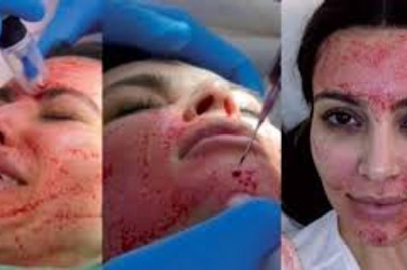 Polémico tratamiento de Kim Kardashian causa alerta por infección sanguínea